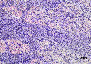 牛伝染性リンパ腫　心臓の白色腫瘤のヘマトキシリン・エオジン染色（心筋に異型リンパ球が浸潤）